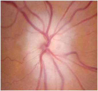 Photo of Arteritic Anterior Ischemic Optic Neuropathy