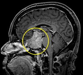MRI of a Pituitary Tumor