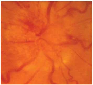 Photo of Ischemic Optic Neuropathy