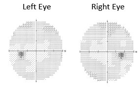 Normal Visual Field Test Results