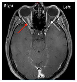 MRI of a patient diagnosed with right optic neuritis
