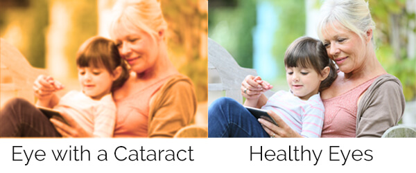 Image showing what it's like to see with cataracts