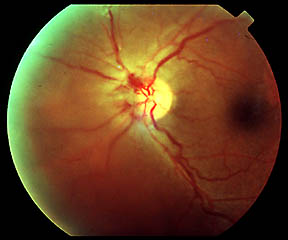Growth around optic nerve in proliferative diabetic retinopathy