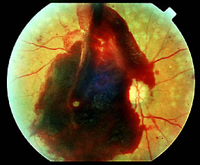 Hemorrhage from new blood vessel growth in proliferative diabetic retinopathy