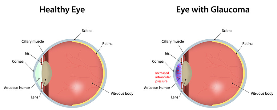 A graphic details the images of an eye with glaucoma compared to an eye without glaucoma.