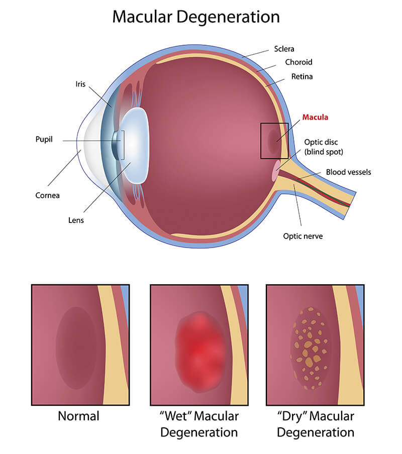 Chart Showing an Eye with Macular Degeneration