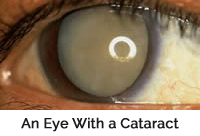 Closeup of an eye with mature cataracts