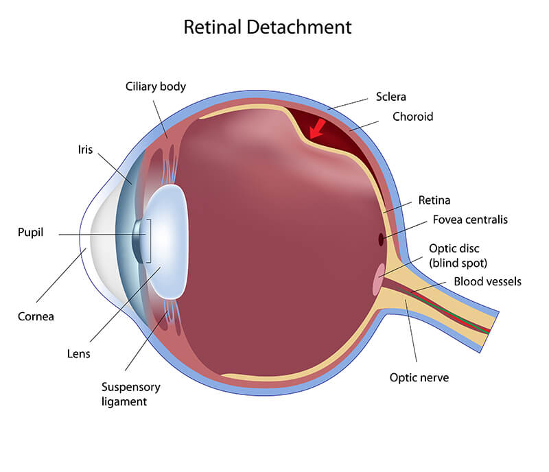 Chart showing retinal detachment in the eye
