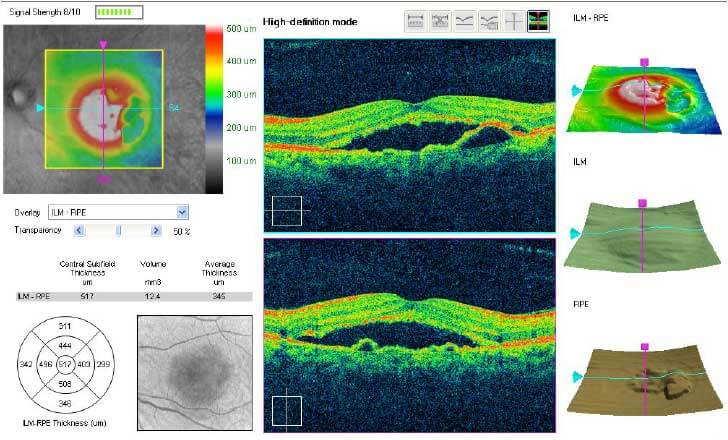 OCT images of an eye with acute central serous chorioretinopathy taken using a commercial spectral-domain OCT device (Cirrus, Carl Zeiss Meditec, Inc).