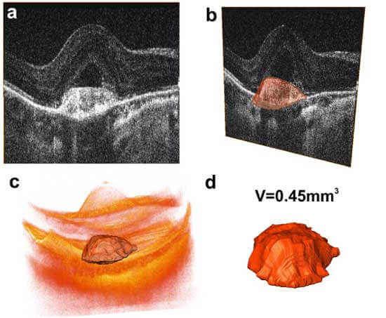 Three-dimensional imaging of a choroidal neovascular membrane secondary to wet age-related macular degeneration, taken using a prototype ultrahigh-resolution spectral-domain OCT device and rendered using commercial software (Amira, FEI Company).