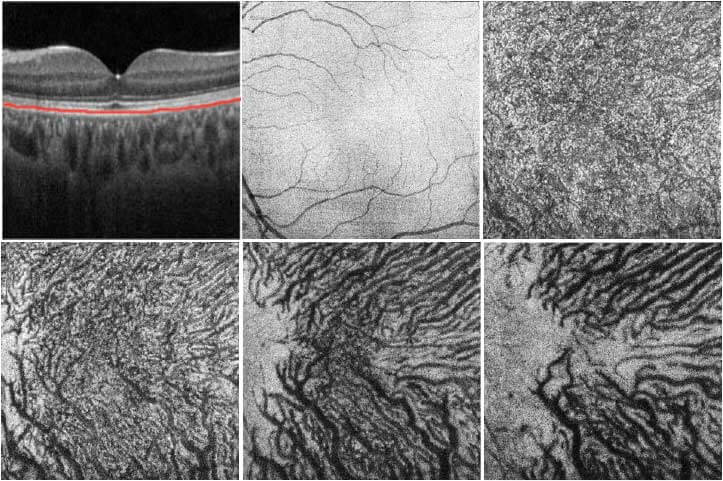 OCT scans through various layers of the choroidal vasculature in a normal eye