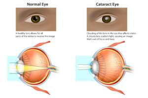 Normal eye versus one with cataracts