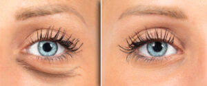 saggy eyelid before and after eyelid surgery