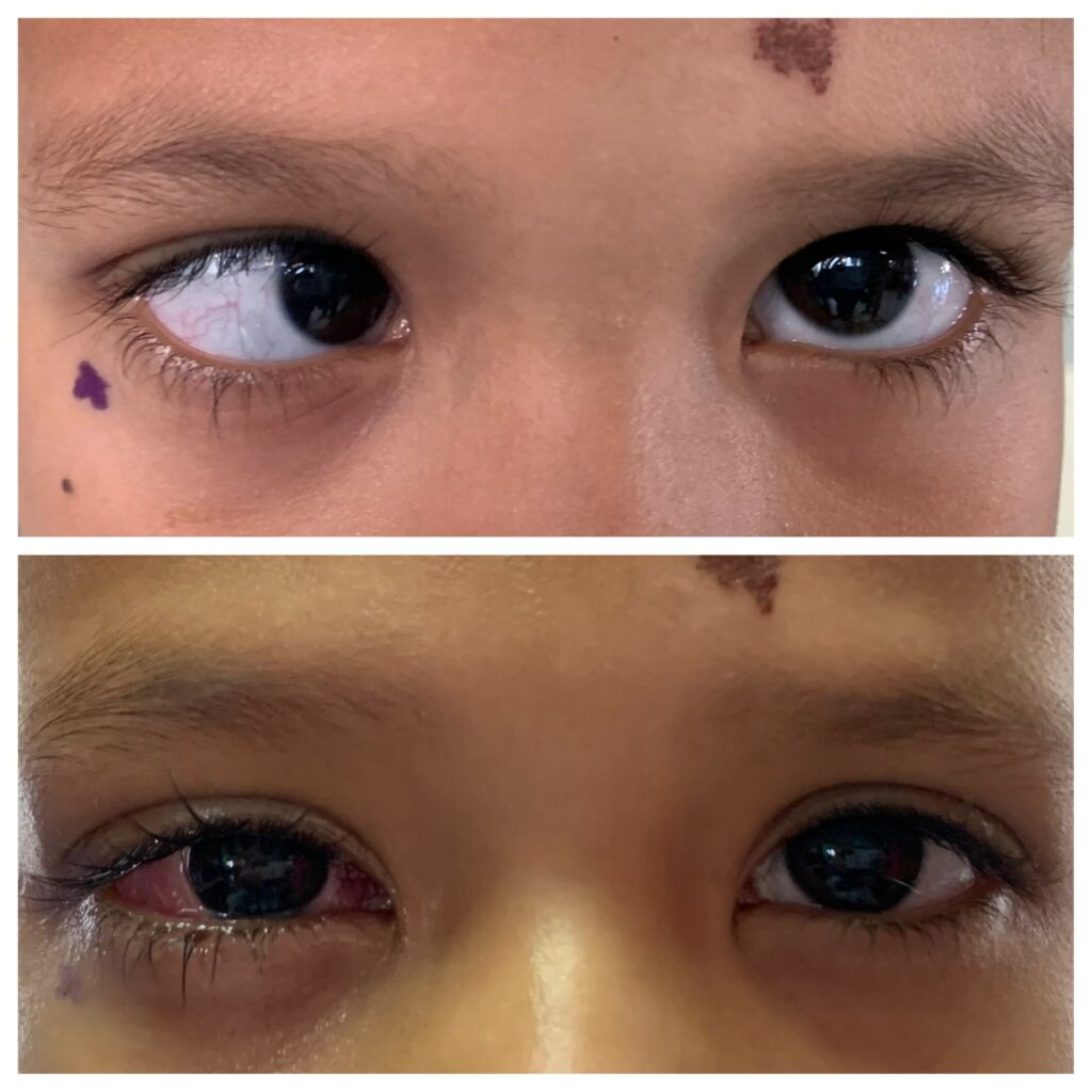Before and after pictures of a patient with esotropia who underwent strabismus surgery with Dr. Yoo. 